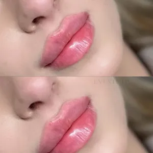 MODELOWANIE UST - Modelowanie ust 1ml - zdjęcie 11