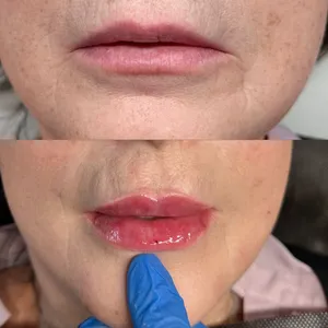 MODELOWANIE UST - Modelowanie ust 0,5 ml - zdjęcie 9