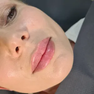 MODELOWANIE UST - Modelowanie ust 1ml - zdjęcie 6